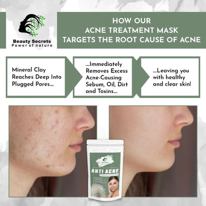 Beauty Secrets Anti Acne Face Mask